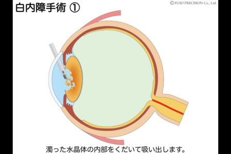 【征集救助云南地区角膜盲症患者】什么是角膜移植？