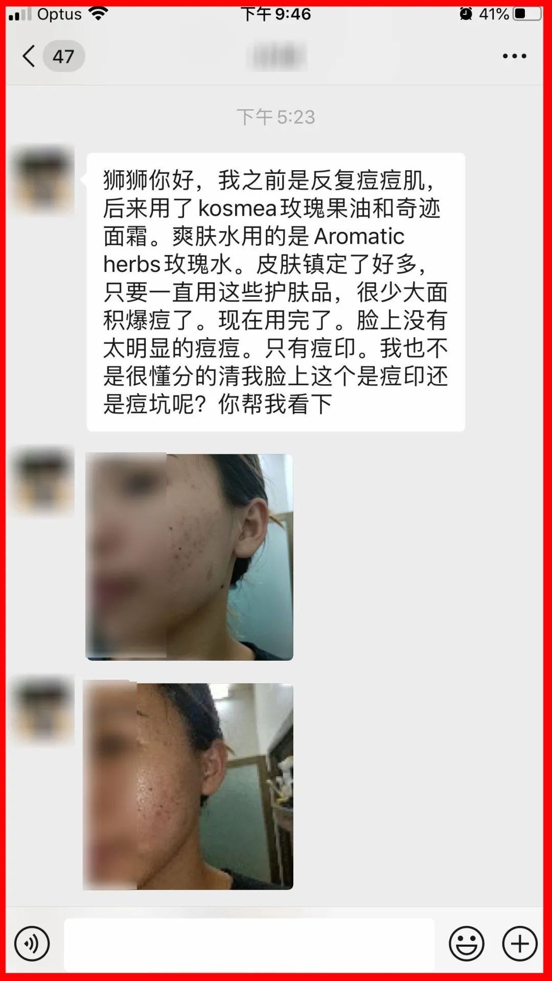 痘印，痘疤，痘坑，不是一回事！产品一定要这么选...